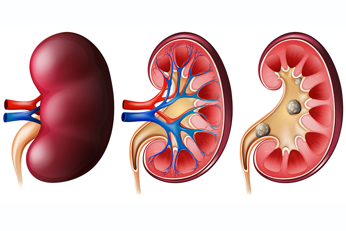 Kidney Stone